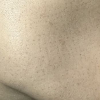 Artisan Beaute' - Scarring covers the entirety of my face. A result of pure negligence. - Medical Spas Near Me - Atlanta, Georgia Artisan Beaute' - Scarring covers the entirety of my face. A result of pure negligence. - Medical Spas Near Me - Atlanta, Georgia