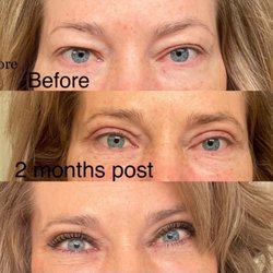 Lorne K Rosenfield, MD - Peninsula Plastic Surgery - Top photo, before the procedure Middle photo , 2 months post op Third photo, 2 months post op with make up