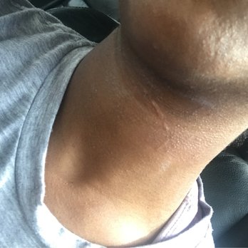 Unique Threading & Body Wax - This is the alert that was left on my neck from their threading services. Went back in to tell them and they did not apologize at all. - Waxing Near Me - Atlanta, Georgia