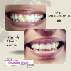 Priyanka Saxena, DDS  - Sparkling Smile Dental - Dental Veneers can change your smile to make you more confident and help you wear a great smile daily!