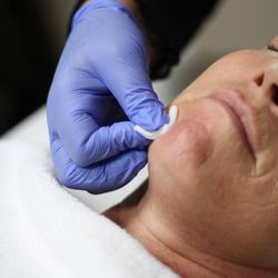 Bella Excellence - Chemical Peel