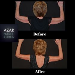 Azar Plastic Surgery & Med Spa - Brachioplasty aka "Arm Lift"