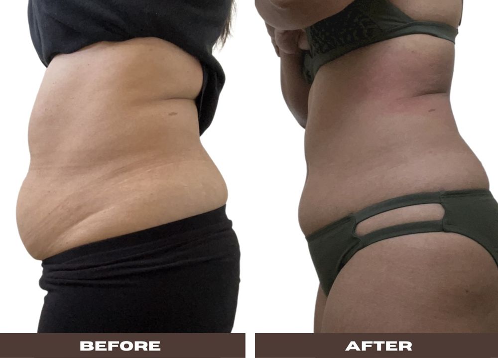 BODY XPERT 7001 Sunne Ln, Walnut Creek, California Body Contouring