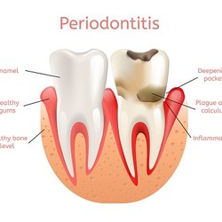 Payal Kshatriya ,DDS - Periodontitis