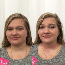 Top Body Contouring - Underchin fat treatment...