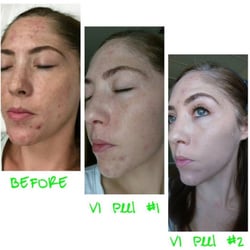 Marina's Oasis Medical Aesthetics - VI Peel progress: No makeup in the last picture (minus mascara and brow powder).  You can also see where I'm still peeling.