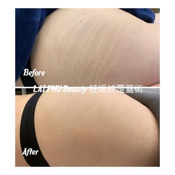 Lai PMU Beauty - Stretch marks removal inkless treatment. - Permanent Makeup Near Me - Arcadia, California Lai PMU Beauty - Stretch marks removal inkless treatment. - Permanent Makeup Near Me - Arcadia, California