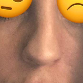 Rod Rohrich, MD - 2yrs post-rhinoplasty. Nose crooked, bumpy, jagged. Tip too low, wide. Tip uneven, crooked nostrils. - Plastic Surgeons Near Me - Dallas, Texas Rod Rohrich, MD - 2yrs post-rhinoplasty. Nose crooked, bumpy, jagged. Tip too low, wide. Tip uneven, crooked nostrils. - Plastic Surgeons Near Me - Dallas, Texas