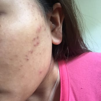Claremont Skin Care - The result after facial - Skin Care Near Me - Oakland, California