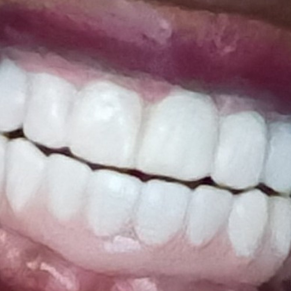 his contouring looks awful look how he didnt add enough bone to that large tooth gumline. He got paid to fix that as well. his contouring looks awful look how he didnt add enough bone to that large tooth gumline. He got paid to fix that as well.