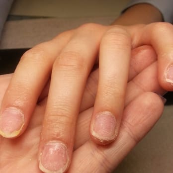 NT NAILS - Severely damaged nails after having the acrylic N.T used taken off. - Nail Salons Near Me - Porterville, California