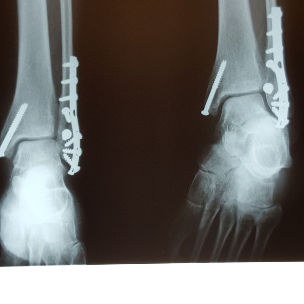 Optimum Physical Therapy - Yes - they CAN help you over come a Trimalleolar Fracture of the ankle like this! - Physical Therapy Near Me - Des Plaines, Illinois