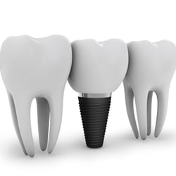 East Lyme Family & Cosmetic Dentistry - Solutions for missing teeth, dental implants may be the answer