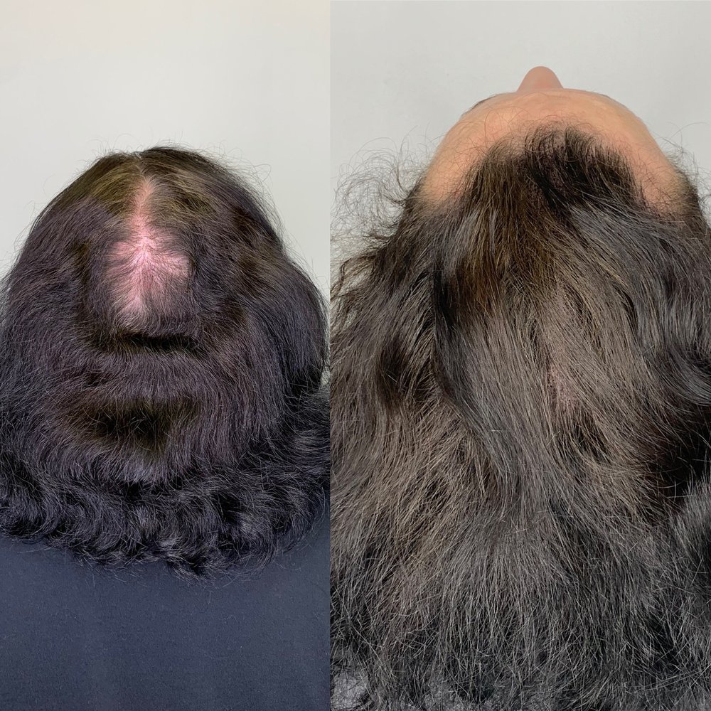 Hair Transplant Lees Summit Missouri