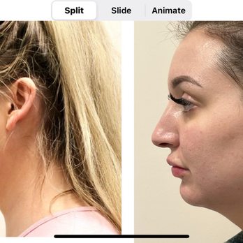 Ice CryoSpa - Side profile of my chin and lip filler! - Cryotherapy Near Me - Falcon, Colorado Ice CryoSpa - Side profile of my chin and lip filler! - Cryotherapy Near Me - Falcon, Colorado