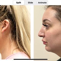 Ice CryoSpa - Side profile of my chin and lip filler!
