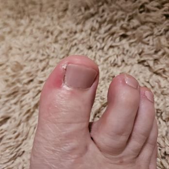 Venetian Nail Spa - My toe is red swollen and painful - Nail Salons Near Me - Coconut Creek, Florida Venetian Nail Spa - My toe is red swollen and painful - Nail Salons Near Me - Coconut Creek, Florida
