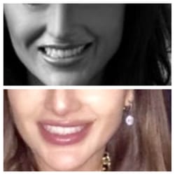 Premier Dermatology - Naperville - I can't thank Dr. Kelleher enough for fixing my smile! Top picture is before - bottom is after correcting with Botox/Filler.