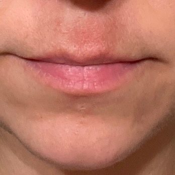 Concierge Medical Aesthetics - Before - Medical Spas Near Me - Folsom, California