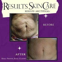 Results Skincare - Microneedling. Collagen induction therapy. Rid those stubborn stretch marks, scarring, sagging skin, wrinkles, & discoloration.