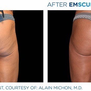 Skin Sanctuary Medspa - Build muscle while burning fat with EmSculpt! - Aestheticians Near Me - Shakopee, Minnesota Skin Sanctuary Medspa - Build muscle while burning fat with EmSculpt! - Aestheticians Near Me - Shakopee, Minnesota