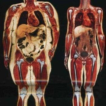 Wellness Integrative Paths - Ideal Protein Weight Loss Protocol: stored body fat is  turned into fuel for energy - Acupuncture Near Me - Columbus, Georgia