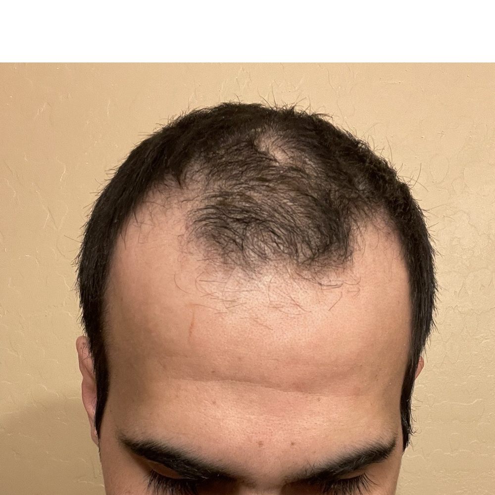 Before the hair transplant Before the hair transplant