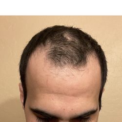 Robotic Hair RX - Before the hair transplant