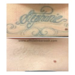 The INK Eraser - Before and after four sessions