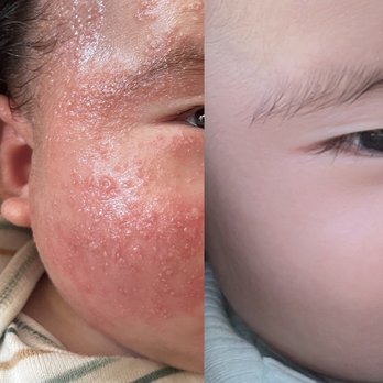 Children's Dermatology - Orange - Right: Pic taken 2/9 (2 days after the treatment) Left: pic taken 2/6 (a day before the treatment) - Dermatologists Near Me - Orange, California
