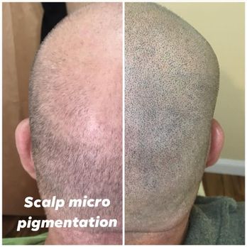 Mane Solution - Scalp micropigmentation - Hair Loss Centers Near Me - Albany, New York Mane Solution - Scalp micropigmentation - Hair Loss Centers Near Me - Albany, New York