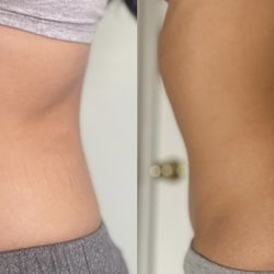 Chelsea Likes Your Face - Results after only 2 cavitation treatments!