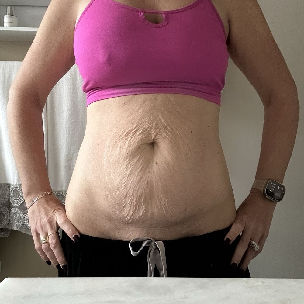 Gaon Plastic Surgery - Before surgery. Saggy stomach from pregnancy and weight loss. My left implant, from a previous surgery in my twenties, was deflated. - Cosmetic Surgeons Near Me - Corona Del Mar, California Gaon Plastic Surgery - Before surgery. Saggy stomach from pregnancy and weight loss. My left implant, from a previous surgery in my twenties, was deflated. - Cosmetic Surgeons Near Me - Corona Del Mar, California