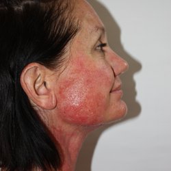 Glad Aesthetics - Immediately after treatment