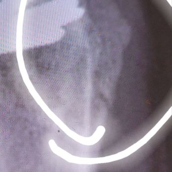 Franciscan Physician Network Orthopedic Specialists - Seven week mark rebreak - Orthopedists Near Me - Indianapolis, Indiana Franciscan Physician Network Orthopedic Specialists - Seven week mark rebreak - Orthopedists Near Me - Indianapolis, Indiana