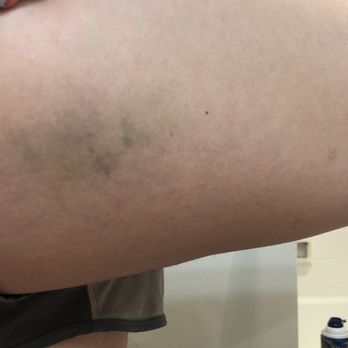 Decades DC - The bruise on my hip from being assaulted. It's still healing 3 weeks later - Dance Clubs Near Me - Washington, DC, District of Columbia