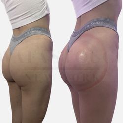 Wafastouch - Service: Non-Surgical Booty Lift  Amazing results our client got in 1 SESSION! Contacts us to book your appointment today