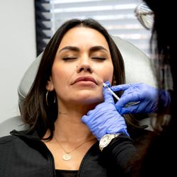 South Bay Med Spa Dermal Filler Treatment.