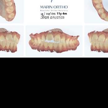 Marin Ortho - 11year old 14 year old Never wore the $5000 Invisalign. JS - Orthodontists Near Me - Larkspur, California Marin Ortho - 11year old 14 year old Never wore the $5000 Invisalign. JS - Orthodontists Near Me - Larkspur, California