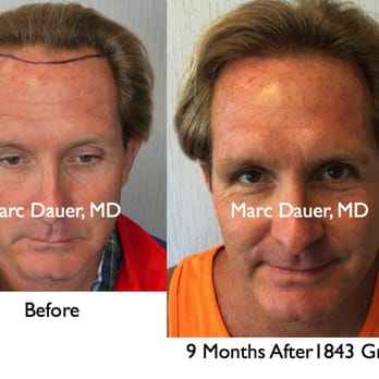 Marc Dauer, MD - Patient happy with the results. - Hair Loss Centers Near Me - Los Angeles, California Marc Dauer, MD - Patient happy with the results. - Hair Loss Centers Near Me - Los Angeles, California