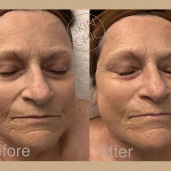 Skin Chic - After just one "Luxe Facial" fine lines and wrinkles, are much softer around the nose, mouth, and forehead. - Skin Care Near Me - Phoenix, Arizona Skin Chic - After just one "Luxe Facial" fine lines and wrinkles, are much softer around the nose, mouth, and forehead. - Skin Care Near Me - Phoenix, Arizona