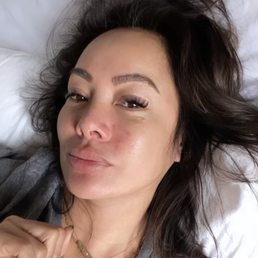 My skin after 6 days with Hydra Facial. You can still see where my acne was. This is without filter. My skin after 6 days with Hydra Facial. You can still see where my acne was. This is without filter.