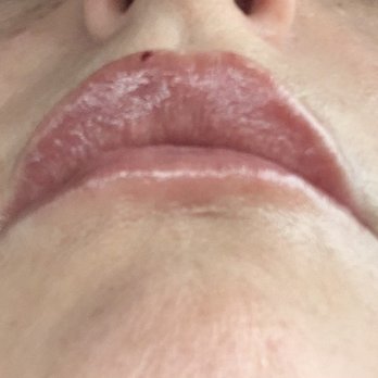 Alani Skin MD - Post filler - Skin Care Near Me - Mesa, Arizona Alani Skin MD - Post filler - Skin Care Near Me - Mesa, Arizona