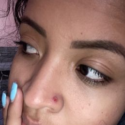 Infection that has been opened