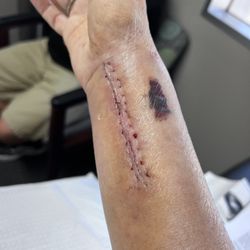 High Desert Orthopedics - 3rd surgery. One week post op