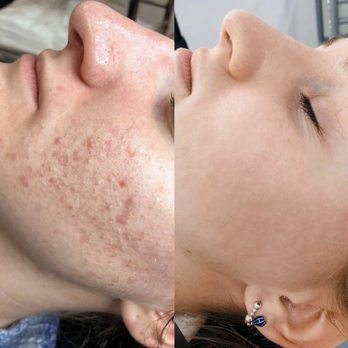 Lips By Nataly - Acne treatment - Skin Care Near Me - New York, New York Lips By Nataly - Acne treatment - Skin Care Near Me - New York, New York