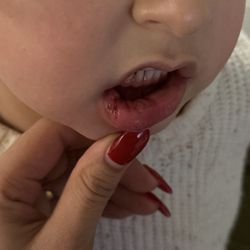 SuperKids Pediatric Dentistry - Injured lip after Dentist appointment.