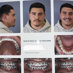 Head & Neck Surgical Associates - This is before my double jaw surgery.