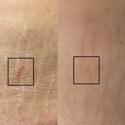 Left: before Right: 3 sessions   The square is the color test Gina did. Once healed, she will go over the area with the pigment!