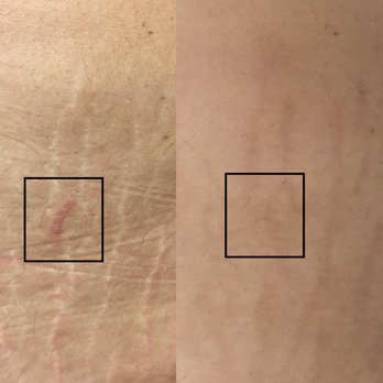 Elevate You Studio - Left: before Right: 3 sessions   The square is the color test Gina did. Once healed, she will go over the area with the pigment! - Permanent Makeup Near Me - South Pasadena , California